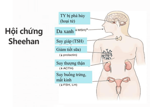 
Hội chứng Sheehan có thể gây ra tình trạng nhồi máu tuyến yên
