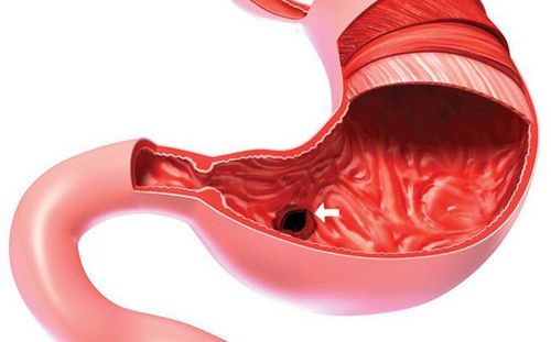 
Viêm dạ dày thứ phát là bệnh khá phổ biến hiện nay

