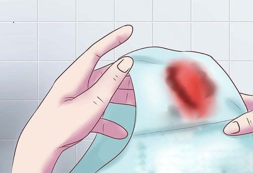Xuất huyết tử cung bất thường do bệnh lý tăng sinh nội mạc tử cung, không rụng trứng...
