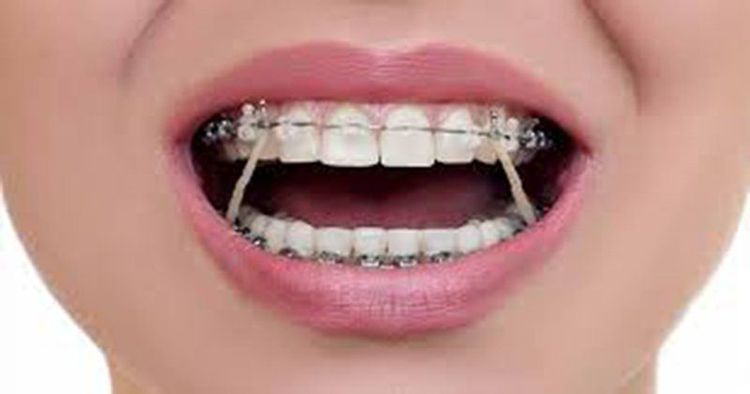 
Thun niềng răng giúp kéo các răng về đúng vị trí mong muốn
