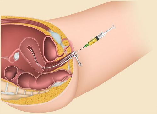 
Cần ít nhất 1 vòi trứng không bị tắc để có thể thực hiện phương pháp thụ tinh nhân tạo IUI
