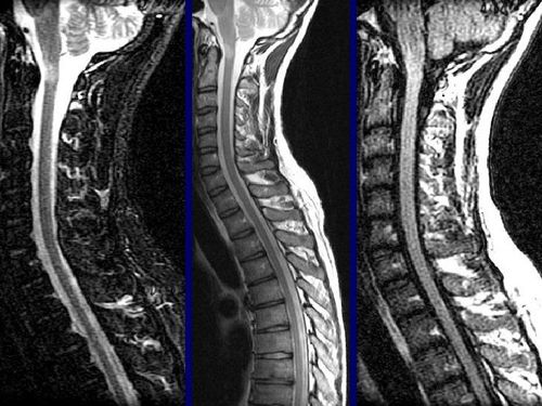 
Hình ảnh chụp MRI cột sống ngực được xử lý qua phần mềm
