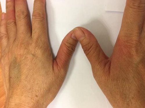 Hồng ban nhiễm sắc cố định