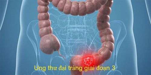 
Ung thư đại trực tràng giai đoạn III
