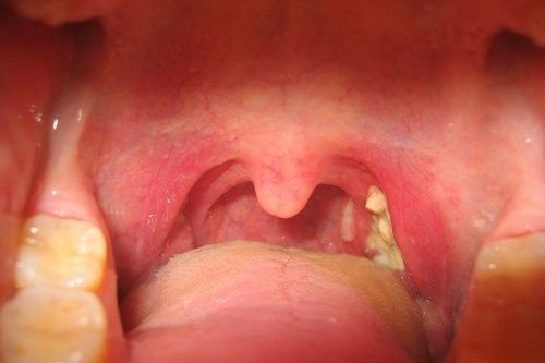
Chủng vi khuẩn hay gây viêm amidan đáy lưỡi nhất là liên cầu khuẩn nhóm A
