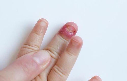 
Cắn móng tay khiến đầu ngón tay đau hoặc chảy máu
