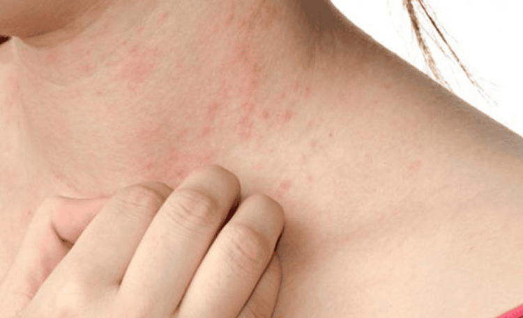 
Sử dụng thuốc bôi chống muỗi trong thời gian dài có thể gây dị ứng da
