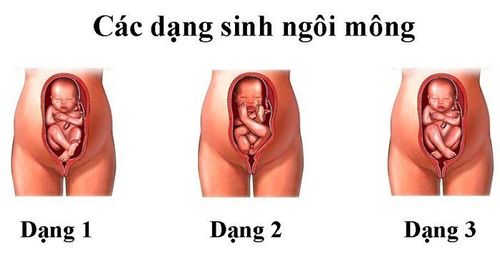 
Thai nhi ngôi mông là một trong những ngôi thai bất thường
