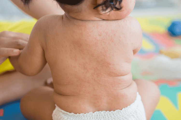 
Phát ban là triệu chứng dị ứng thường gặp khi bị côn trùng đốt
