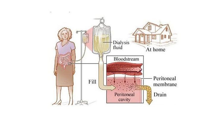
Phương pháp lọc màng bụng ngắt quãng có thể được thực hiện tại nhà
