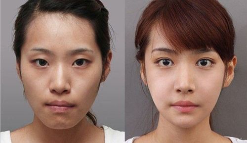 
Thay đổi khuôn mặt trước và sau niềng răng
