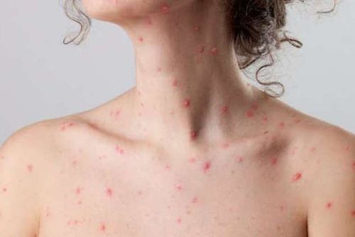 
Thủy đậu mọc quá nhiều có thể gây nên tình trạng bội nhiễm da và để lại sẹo
