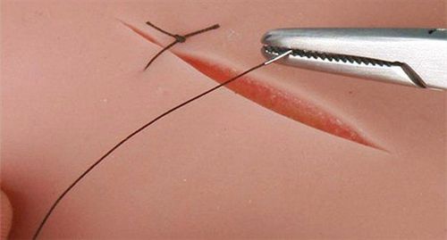 
Đối với trường chấn thương đường sinh dục hợp sẽ may lại tầng sinh môn hoặc các vết rách ở đường sinh dục bằng chỉ tự tiêu
