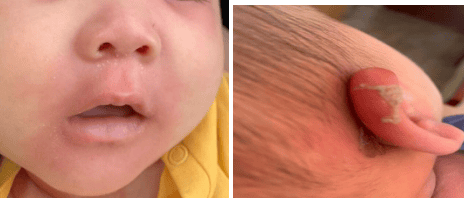 Hội chứng bong da do tụ cầu: Những điều cần biết