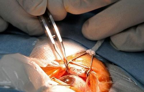 
Sau phẫu thuật điều trị đục thủy tinh thể có thể gây bong võng mạc

