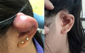 
Xỏ khuyên tai có thể hình thành viêm màng sụn tai
