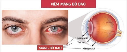 
Bệnh viêm màng bồ đào khiến tầm nhìn kém đi hoặc gây mù lòa

