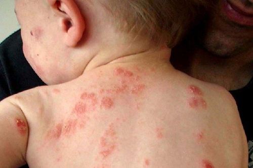 
Chốc lở ngoài da ở trẻ thường xảy ra ở bé trai nhiều hơn bé gái
