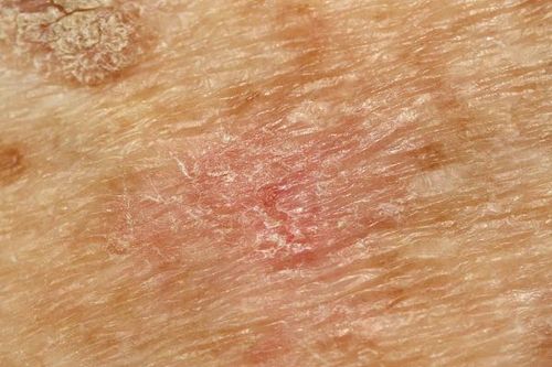 
Tổn thương da do dày sừng ánh nắng khá đa dạng với nhiều màu sắc khác nhau
