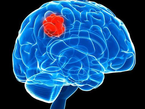 
Vi khuẩn kỵ khí xâm nhập hệ thần kinh trung ương gây ra nhiều biến chứng nghiêm trọng
