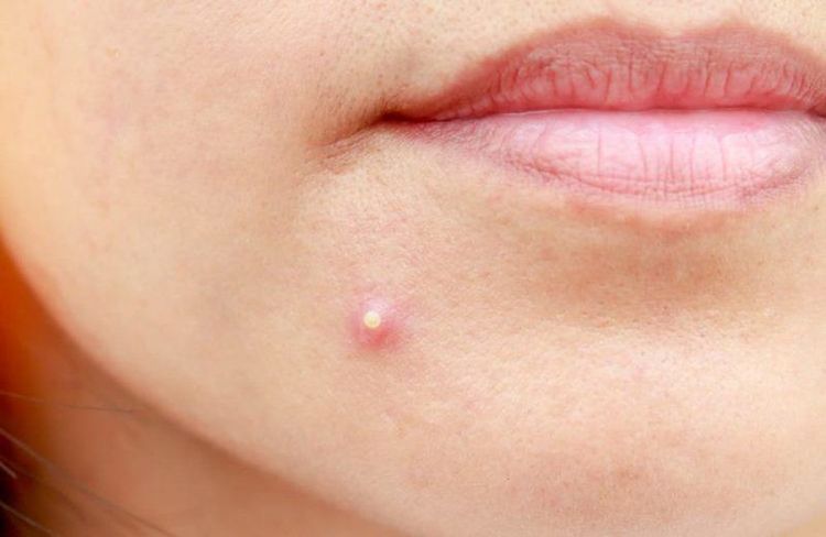 
Propionibacterium: là loại vi khuẩn cư trú nhiều trên bề mặt da, có thể gây tình trạng mụn trứng cá
