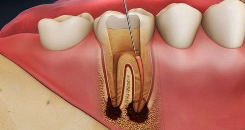 
Đau tủy răng là một trong các nguyên nhân làm cho răng nhạy cảm dễ bị đau
