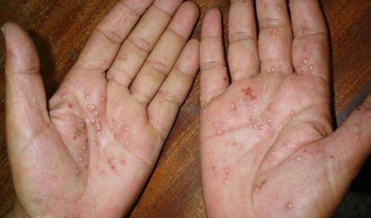 
Vảy nến thể mủ xuất hiện trong lòng bàn tay

