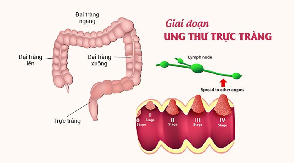 
Hình ảnh các giai đoạn ung thư đại trực tràng
