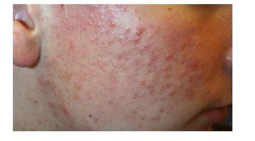 
Nốt sần trên da có thể là mụn
