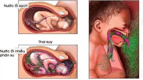 
Hình ảnh hít ối phân su
