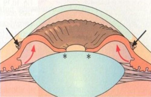 
Glaucoma góc đóng cần được phẫu thuật cắt mống mắt chu biên
