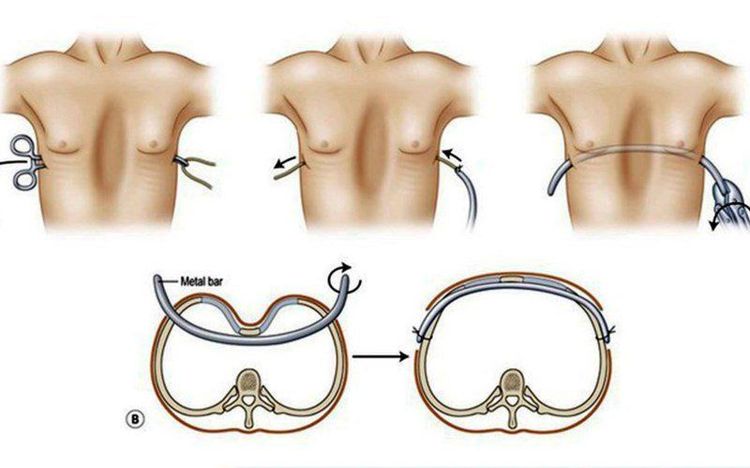 
Sử dụng 1 thanh kim loại để nâng xương chỗ ngực vùng lõm
