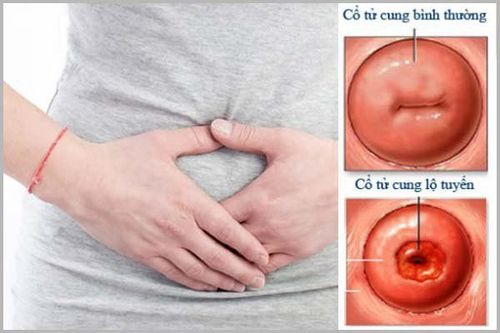 
Viêm lộ tuyến là một bệnh lành tính phổ biến ở phụ nữ

