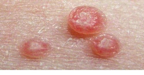 
U mềm lây có thể xuất hiện trên một mảng
