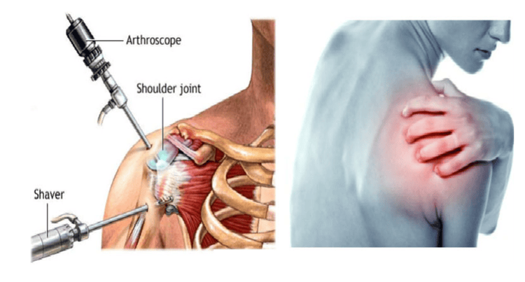 
Tiêm thuốc gây tê càng trên xương đòn và gần cột sống thì khả năng gây tê các nhánh thần kinh càng dễ
