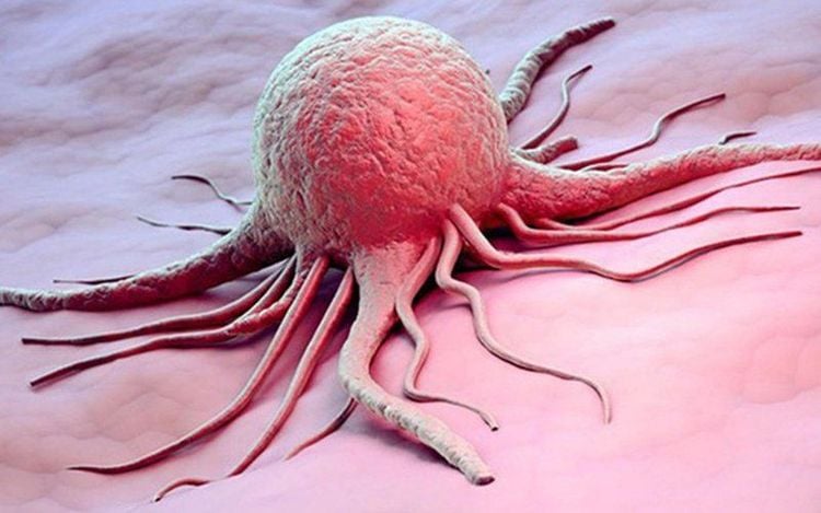 Kích thước khối u giúp đánh giá giai đoạn bệnh của ung thư