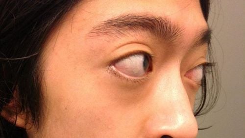
Tình trạng mắt bị lồi do bệnh lý tuyến giáp basedow
