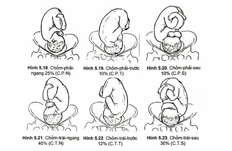 
6 kiểu thế lọt của ngôi chỏm
