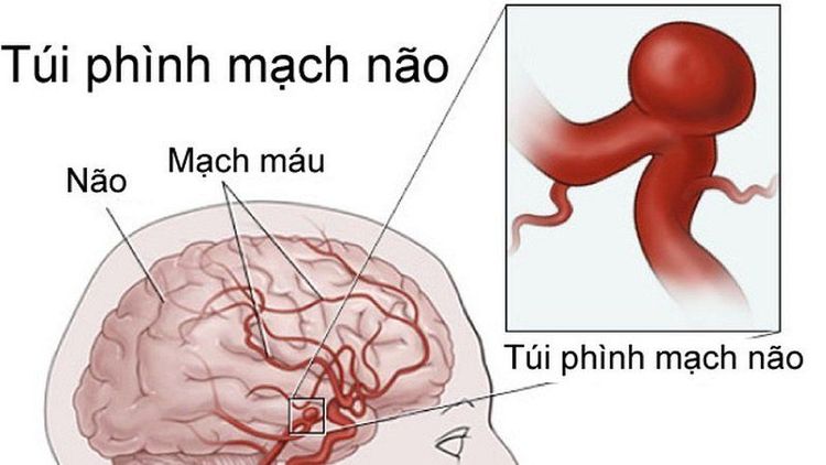 
Vỡ túi phình mạch máu não là nguyên nhân chính dẫn tới xuất huyết dưới nhện
