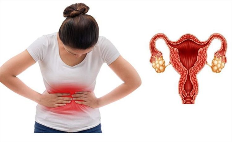Hiếm muộn do bị đa nang buồng trứng phải làm sao?