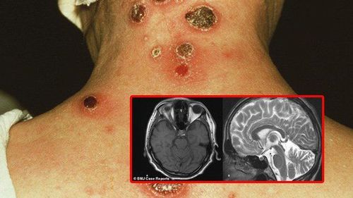 
Bệnh giang mai có thể gây ra nhiều biến chứng nguy hiểm

