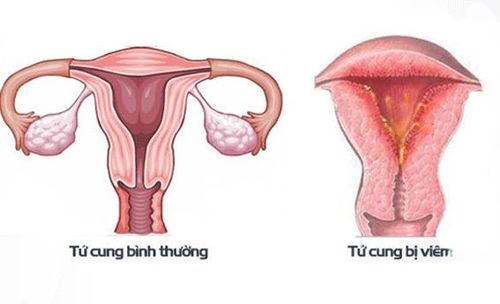 
Viêm nội mạc tử cung là một trong những loại nhiễm trùng sau sinh thường gặp nhất
