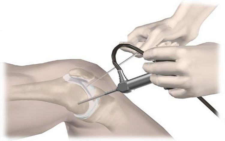 
Vai trò của nội soi khớp gối là cực kỳ quan trọng và có ý nghĩa to lớn trong việc điều trị bệnh lý thoái hóa khớp gối
