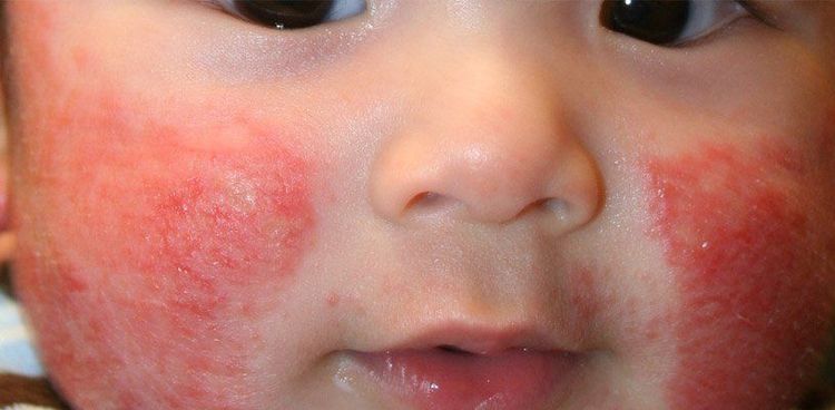 
Chàm sữa là bệnh có tính chất di truyền từ gia đình
