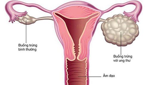 
PNS xảy ra nhiều ở ung thư buồng trứng

