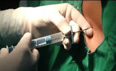 
Gây tê khoang ngoài màng cứng khi chọc thủng màng cứng là nguyên nhân gây đau đầu
