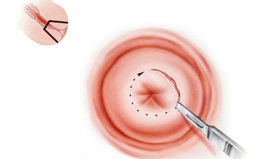 
Khoét chóp cổ tử cung là thủ thuật cắt bỏ một phần hình nón của cổ tử cung do tổn thương
