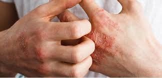 
Viêm khớp vảy nến là yếu tố gây ra các bệnh về tim mạch
