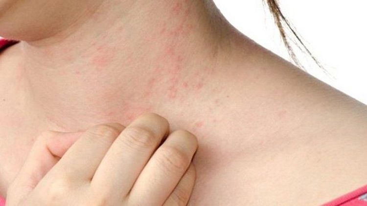 
Dị ứng thực phẩm là một trong các yếu tố nguy cơ làm tăng khả năng khởi phát bệnh
