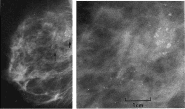 Vi vôi hóa có thể quan sát được trên phim chụp nhũ ảnh